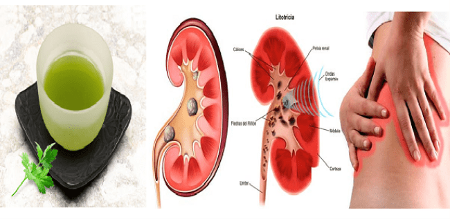 En 6 Dias Eliminaras Las Piedras En Los Rinones Con Este Remedio