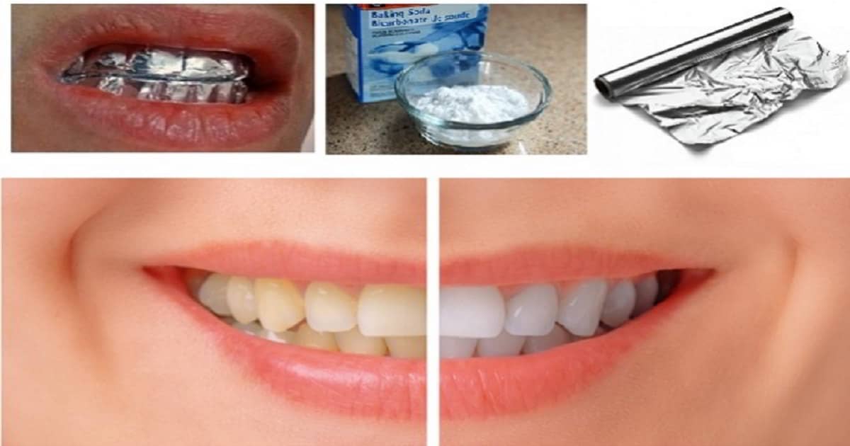 Papel de aluminio para blanquear los dientes - Beliefnet