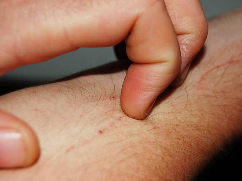 Psoriasis and Eczema: What&#39;s the Difference? | Difference Between Psoriasis  and Eczema | Symptoms of Eczema and Psoriasis | Common Skin Conditions -  Beliefnet