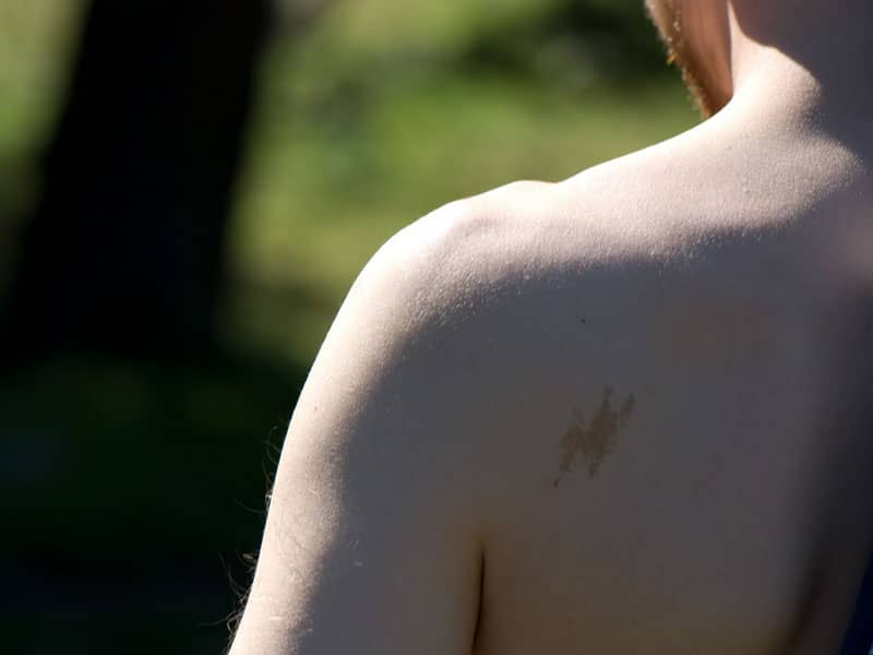 Birthmark on Back